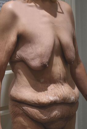 Massive Weight Loss : Case 201 - Before