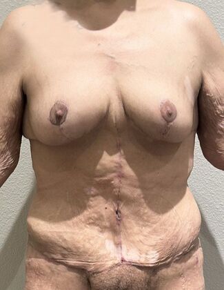 Massive Weight Loss : Case 201 - After