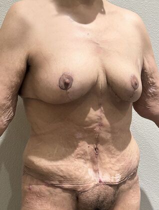 Massive Weight Loss : Case 201 - After