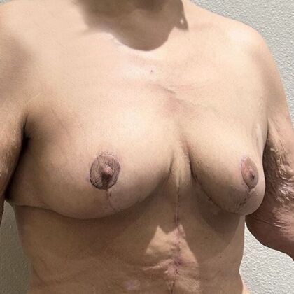 Breast Lift (Mastopexy): Case 259 - After