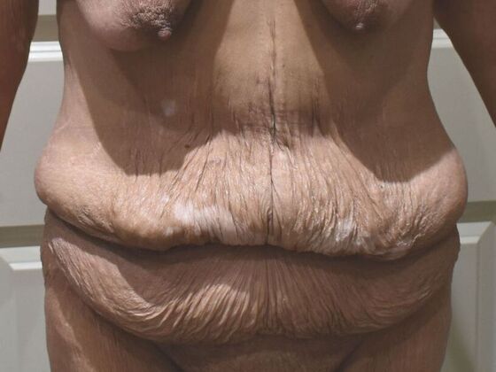 Tummy Tuck (Abdominoplasty): Case 574 - Before