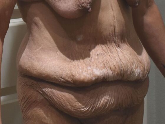 Tummy Tuck (Abdominoplasty): Case 574 - Before