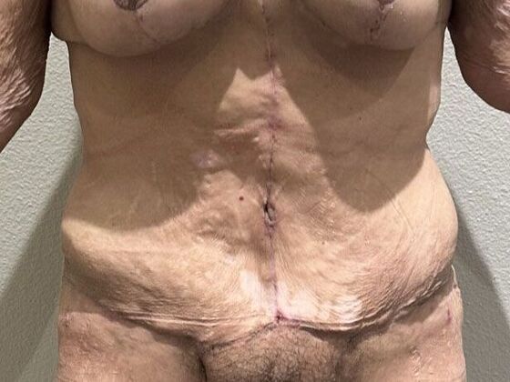 Tummy Tuck (Abdominoplasty): Case 574 - After