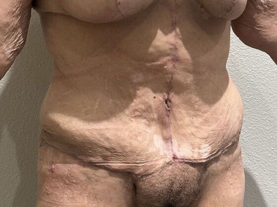 Tummy Tuck (Abdominoplasty): Case 574 - After