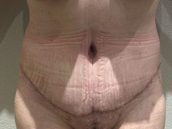 Tummy Tuck (Abdominoplasty): Case 23 - After
