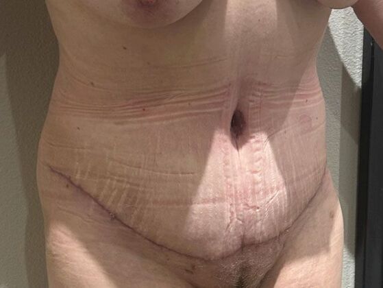 Tummy Tuck (Abdominoplasty): Case 23 - After