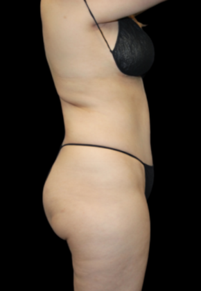 Brazilian Butt Lift: Case 1 - Before