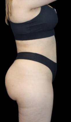 Brazilian Butt Lift: Case 1 - After