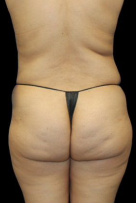 Brazilian Butt Lift: Case 1 - Before