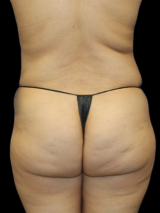 Brazilian Butt Lift BBL 20 - Before