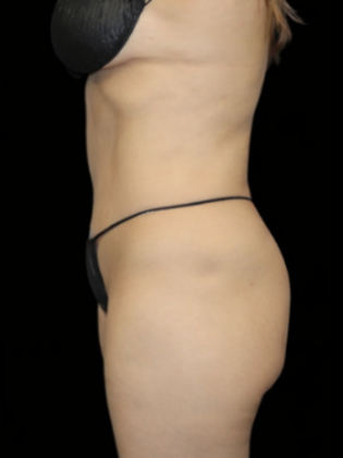 Brazilian Butt Lift Case 1 - Before