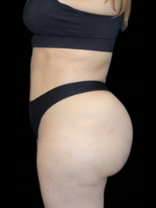 Brazilian Butt Lift Case 1 - After