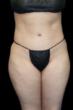 Brazilian Butt Lift: Case 1 - Before