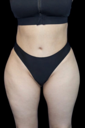 Brazilian Butt Lift: Case 1 - After