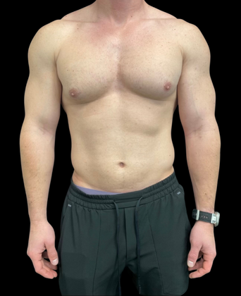 Gynecomastia Case 1 - Before