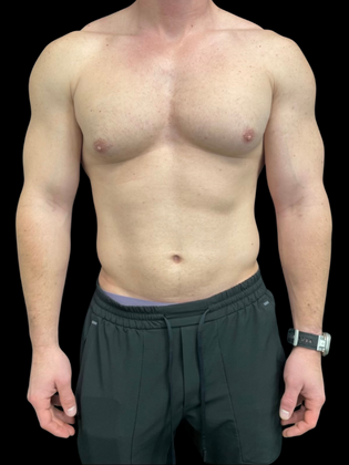 Gynecomastia Gynecomastia 1 - Before