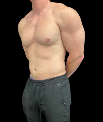 Gynecomastia: Case 1 - Before