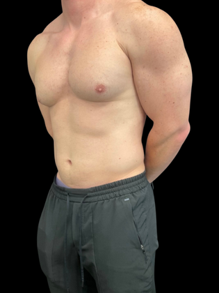 Gynecomastia: Gynecomastia 1 - Before