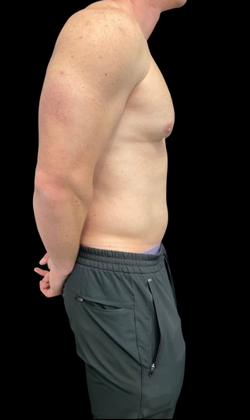 Gynecomastia: Case 1 - Before