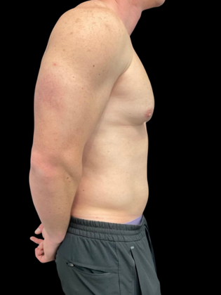 Gynecomastia: Gynecomastia 1 - Before