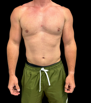 Gynecomastia Case 1 - After