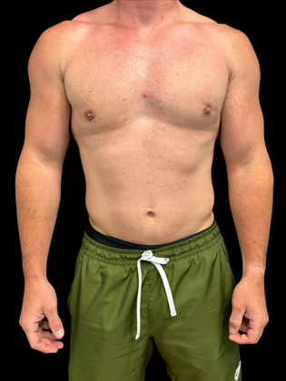 Gynecomastia Gynecomastia 1 - After