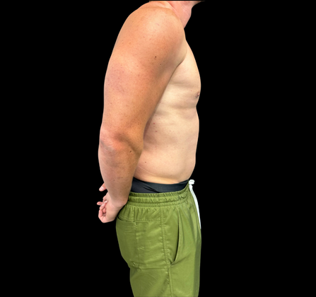 Gynecomastia: Case 1 - After