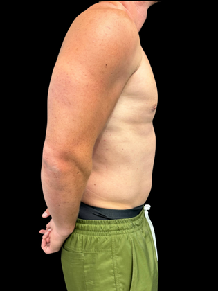 Gynecomastia: Gynecomastia 1 - After