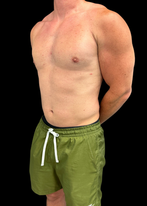 Gynecomastia: Case 1 - After