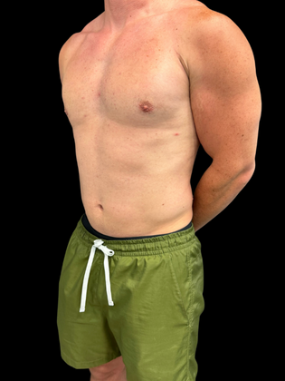 Gynecomastia: Gynecomastia 1 - After