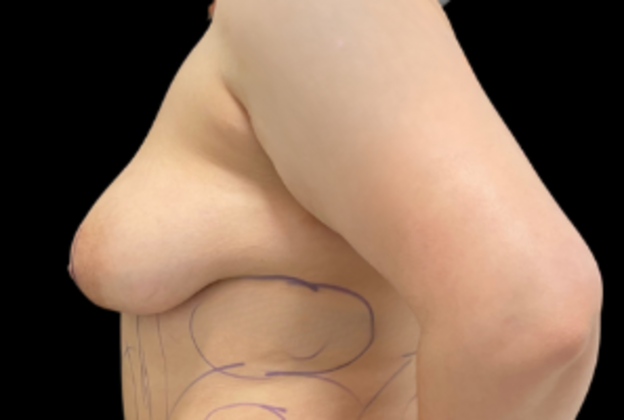 Breast Augmentation: Case 1 - Before
