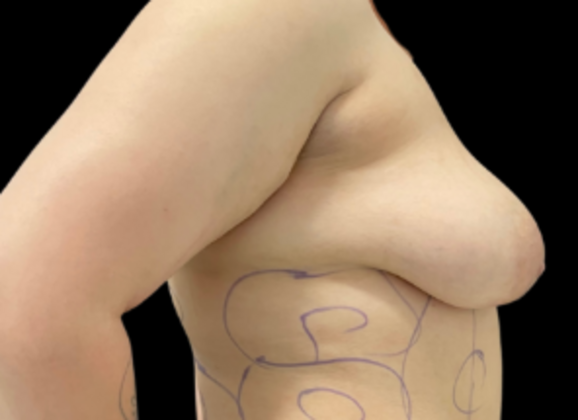 Breast Augmentation: Case 1 - Before