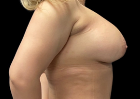 Breast Augmentation: Case 1 - After