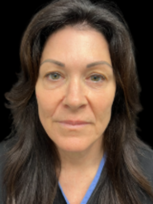 Face & Neck Lifts Facelift 4 - Before