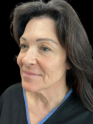 Face & Neck Lifts: Facelift 4 - Before