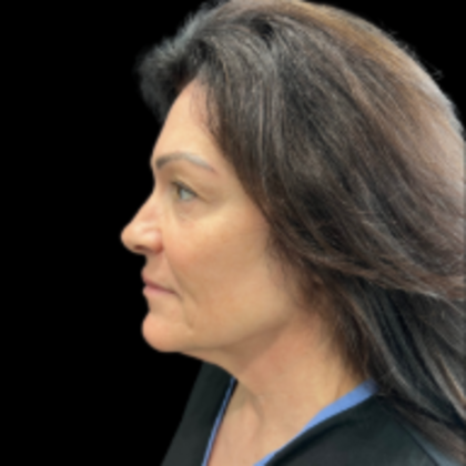 Face & Neck Lifts: Case 1 - Before