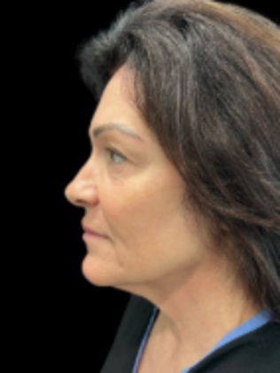 Face & Neck Lifts: Facelift 4 - Before