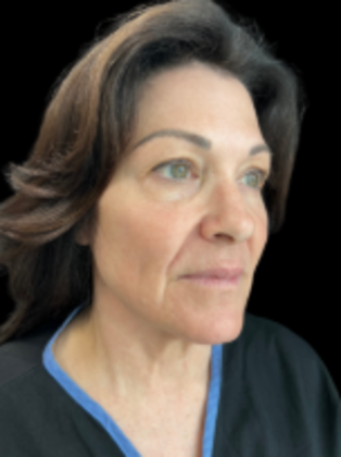 Face & Neck Lifts: Facelift 4 - Before