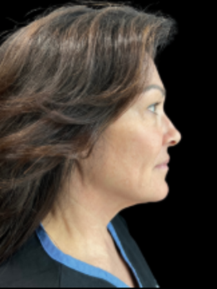 Face & Neck Lifts: Case 1 - Before