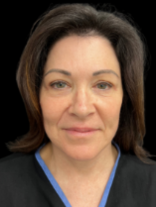 Face & Neck Lifts Facelift 4 - After