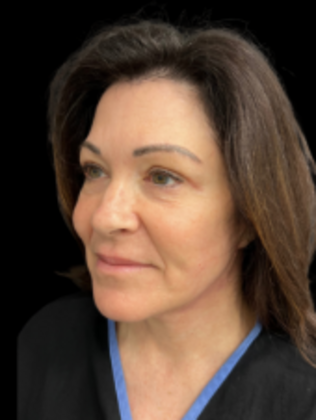 Face & Neck Lifts: Facelift 4 - After