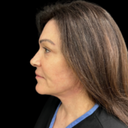 Face & Neck Lifts: Case 1 - After