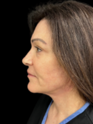 Face & Neck Lifts: Facelift 4 - After