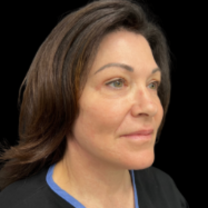 Face & Neck Lifts: Case 1 - After