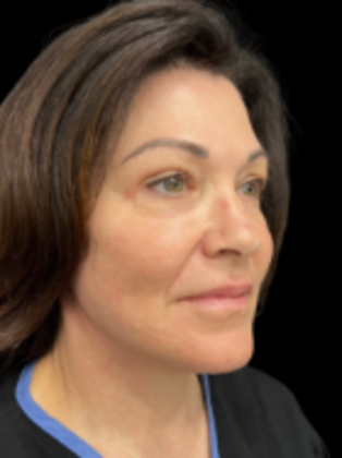Face & Neck Lifts: Facelift 4 - After