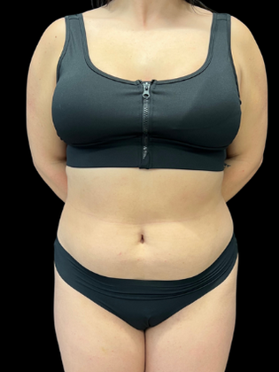 Liposuction Case 1 - Before