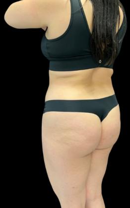 Liposuction: Case 1 - Before