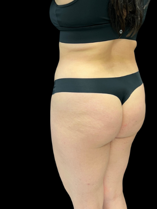 Liposuction: Liposuction 4 - Before