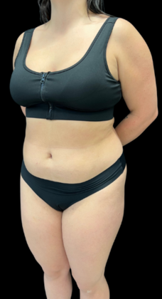 Liposuction: Case 1 - Before