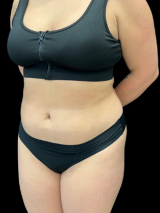 Liposuction: Liposuction 4 - Before